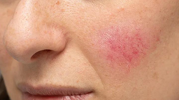 juckender hautausschlag gesicht - Warum ist mein Gesicht rot und juckt