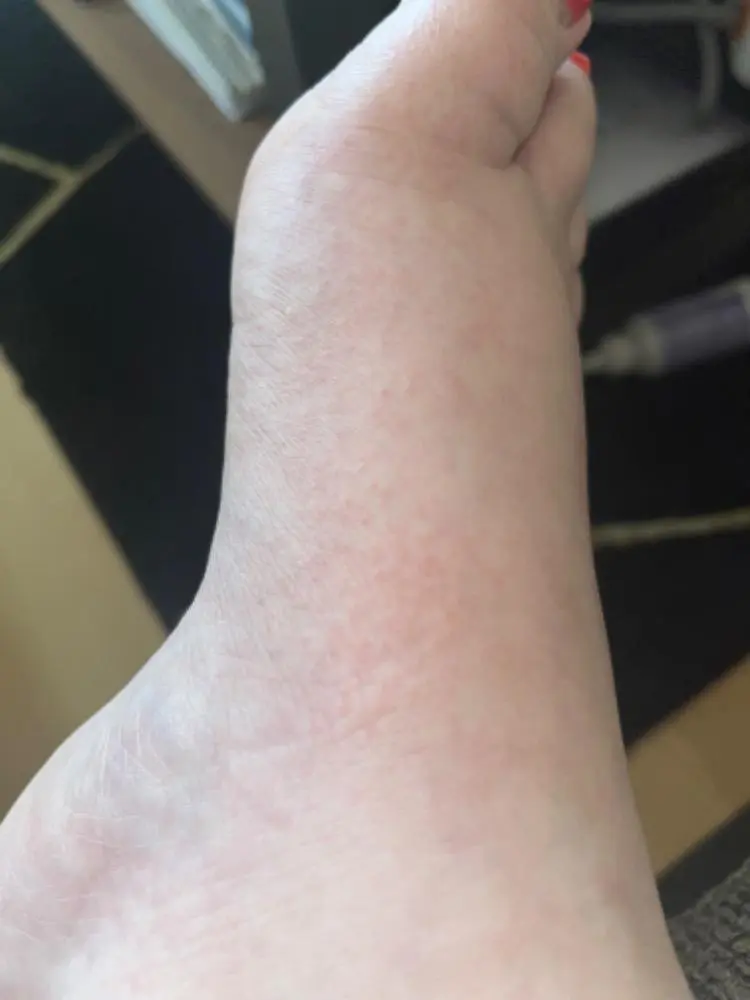 füße jucken schwangerschaft - Warum jucken meine Füße während der Schwangerschaft