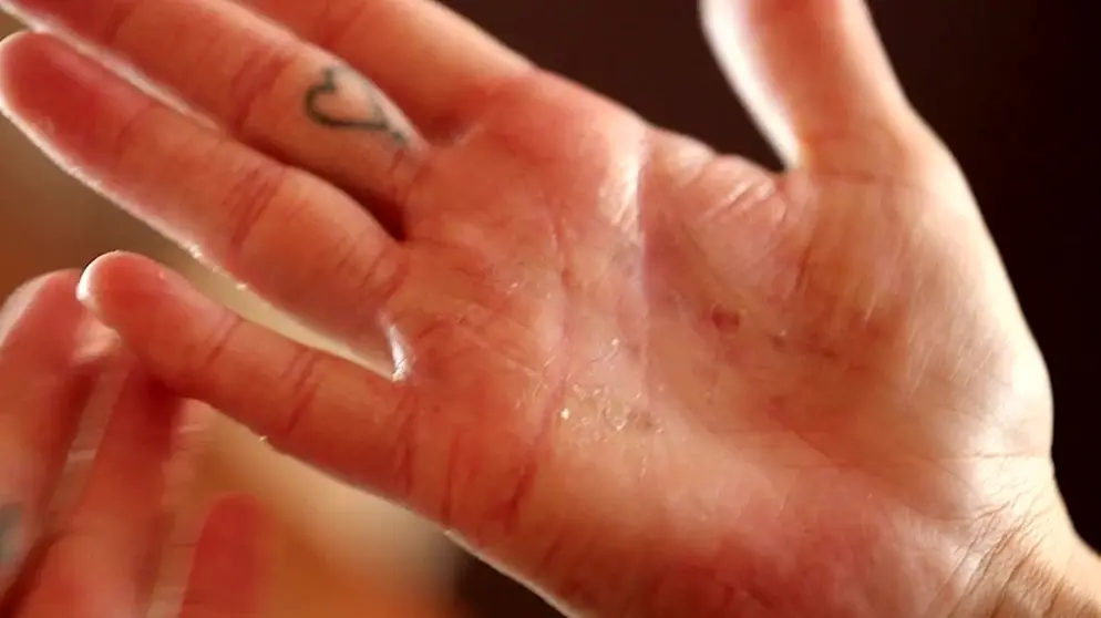 juckende hände schwangerschaft - Warum jucken plötzlich die Hände