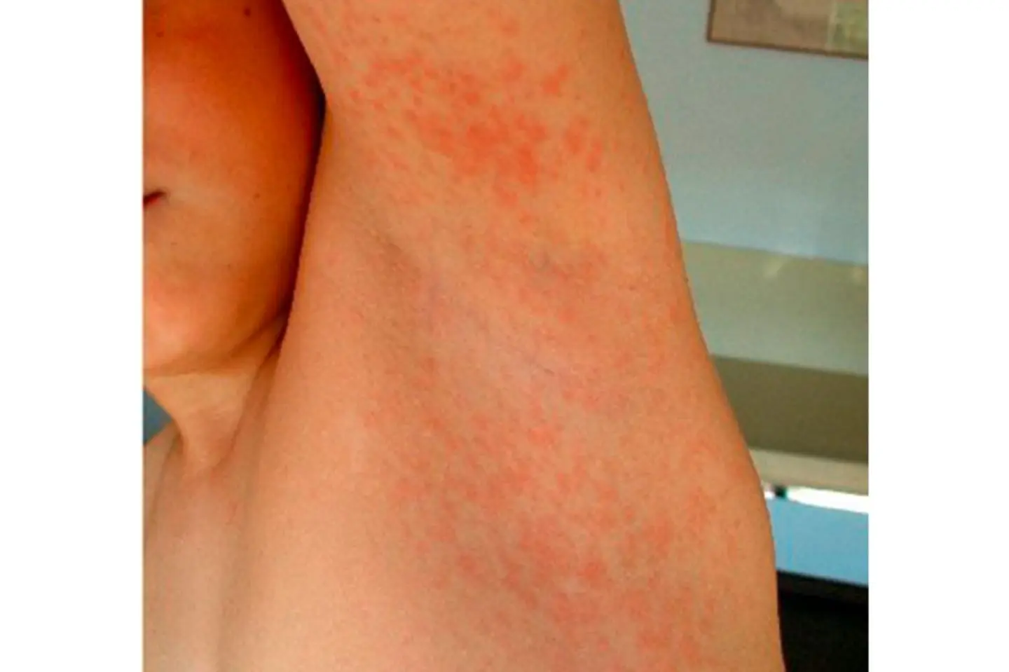 jucken achselhöhle - Warum kitzelt es unter den Achseln