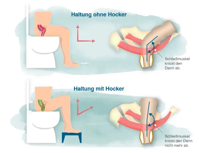 nach geburt stuhlgang kommt nicht raus - Warum kommt der Stuhlgang nicht raus