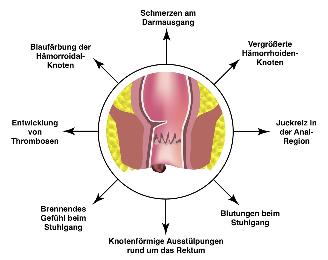 krämpfe vor stuhlgang schwangerschaft - Warum Krämpfe vor Stuhlgang