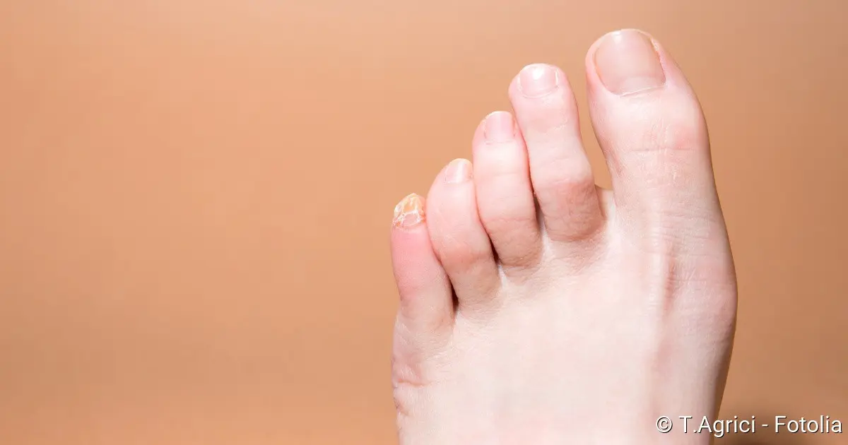 gekrümmte zehen - Warum krümmen sich meine Zehen