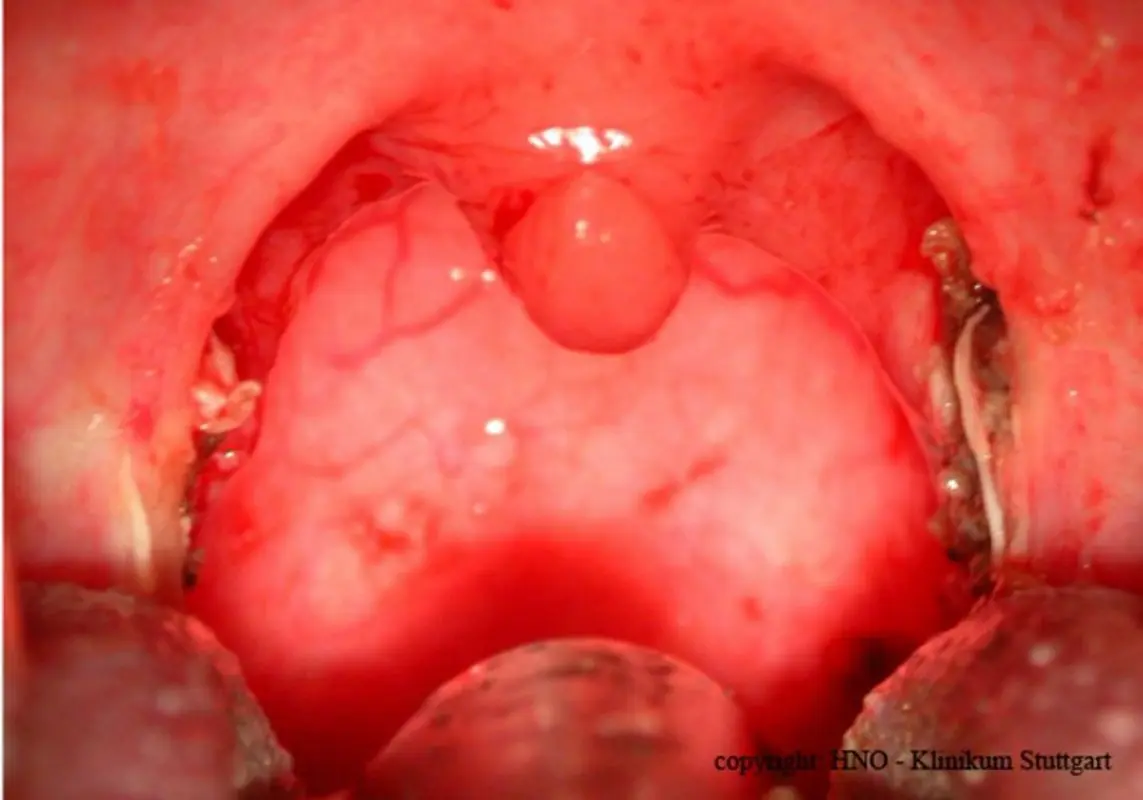Mandeln und Polypen: Was ist der Unterschied? - Warum Mandeln und Polypen entfernen bei Kindern mandeln und polypen - Warum Mandeln und Polypen entfernen bei Kindern