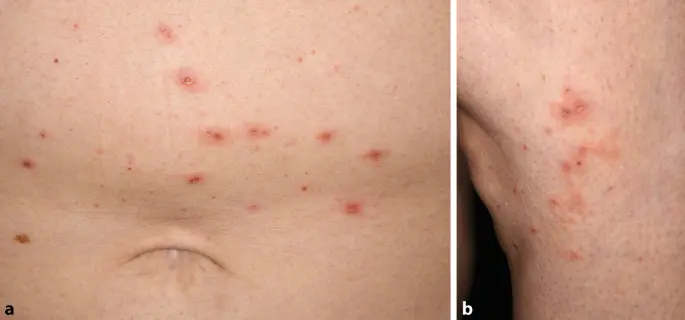 ekzeme schwangerschaft - Warum plötzlich Ekzeme