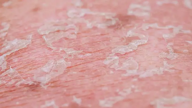 schuppige haut schwangerschaft - Warum plötzlich schuppige Haut