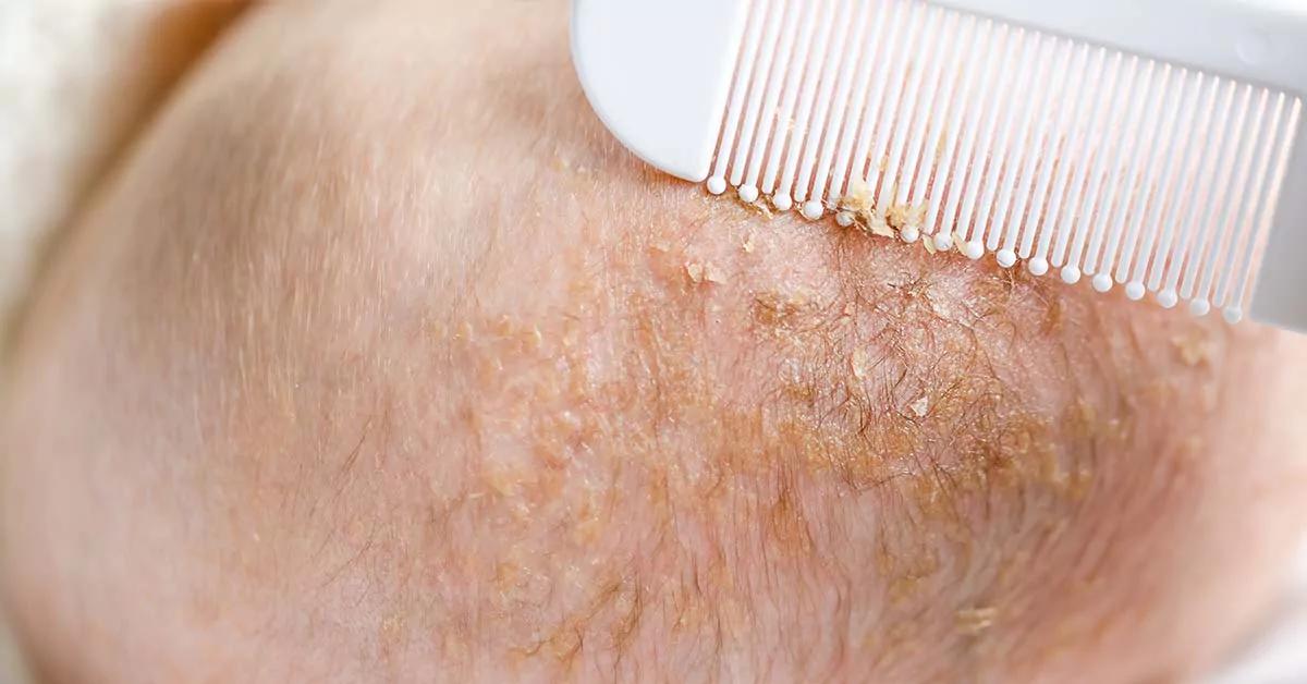 kopfgneis - Warum riecht Kopfgneis