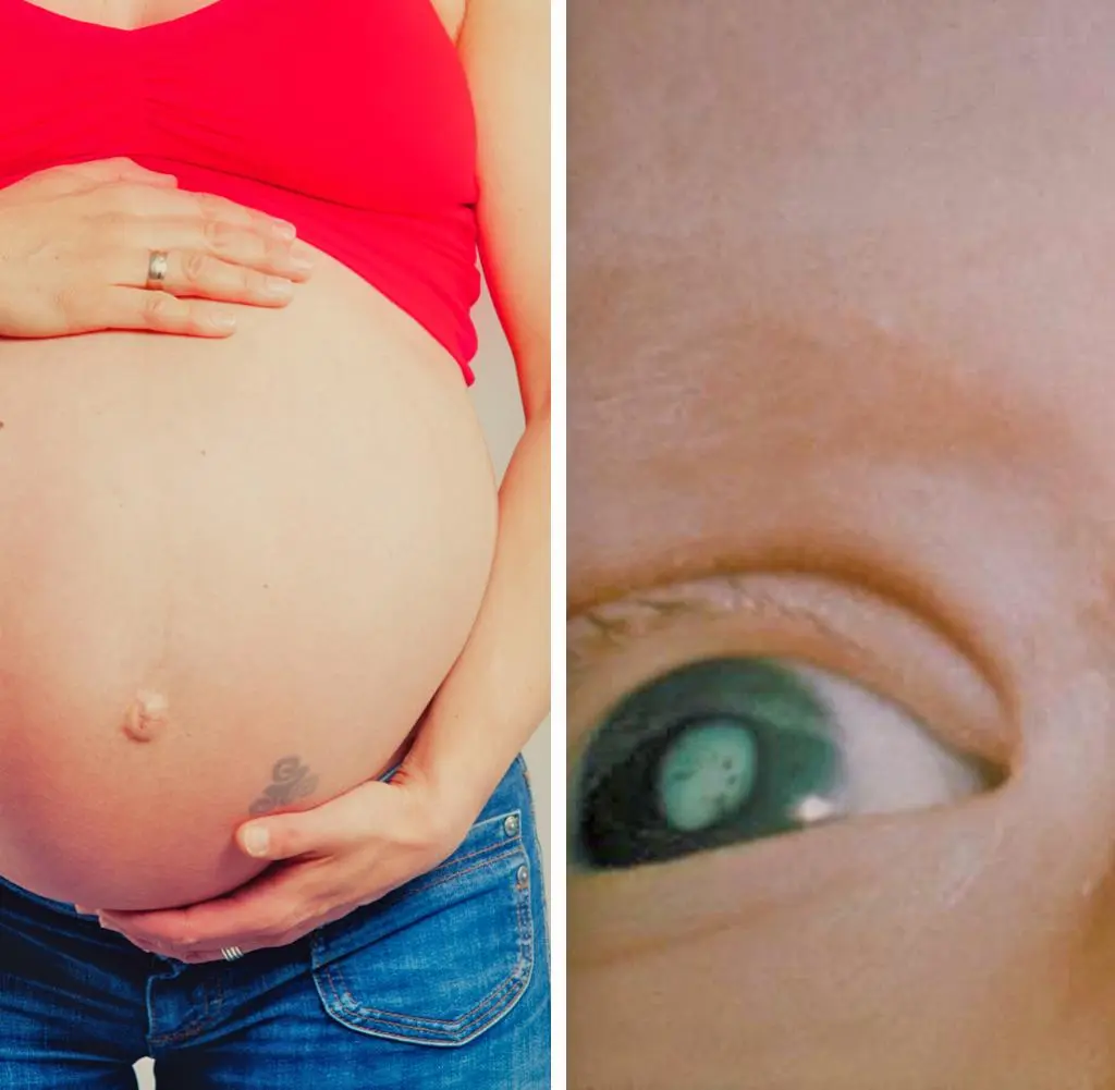 rötel schwangerschaft - Warum Ringelröteln ab 20 SSW nicht mehr gefährlich