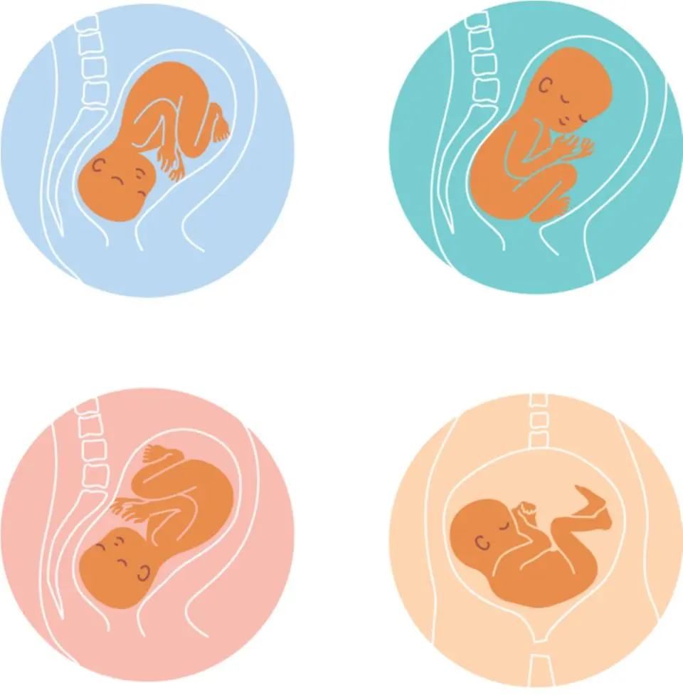 sternengucker baby geburt - Warum schaut mein Baby immer nach oben