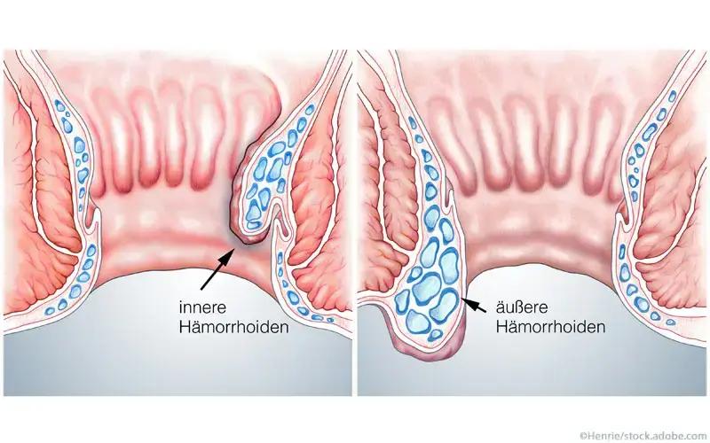 akute hämorrhoiden schmerzen - Warum Schmerzen Hämorrhoiden plötzlich