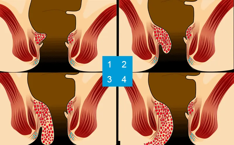 hämorrhoiden starke schmerzen - Warum sind Hämorrhoiden so schmerzhaft