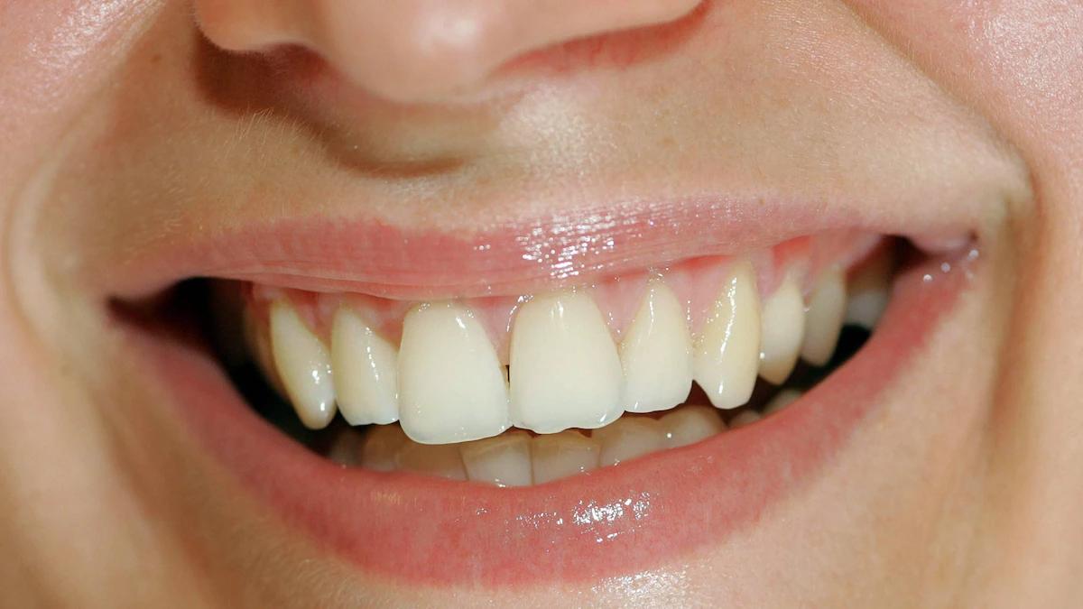 Gelbe Eckzähne: Ursachen, Vorbeugung und Behandlung - Warum sind meine Zähne auf einmal so gelb eckzähne gelb - Warum sind meine Zähne auf einmal so gelb