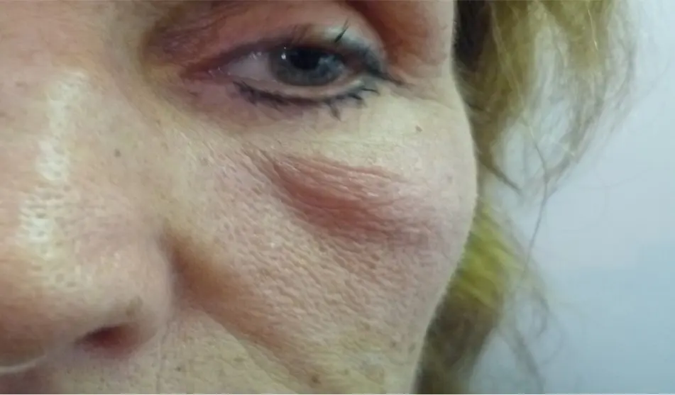 jochbein schwellung - Warum tut das Jochbein weh