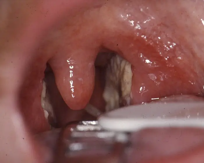 Schluckbeschwerden bei Mandelentzündung: Ursachen, Symptome und Behandlung - Warum tut Schlucken bei Mandelentzündung weh schluckbeschwerden mandelentzündung - Warum tut Schlucken bei Mandelentzündung weh