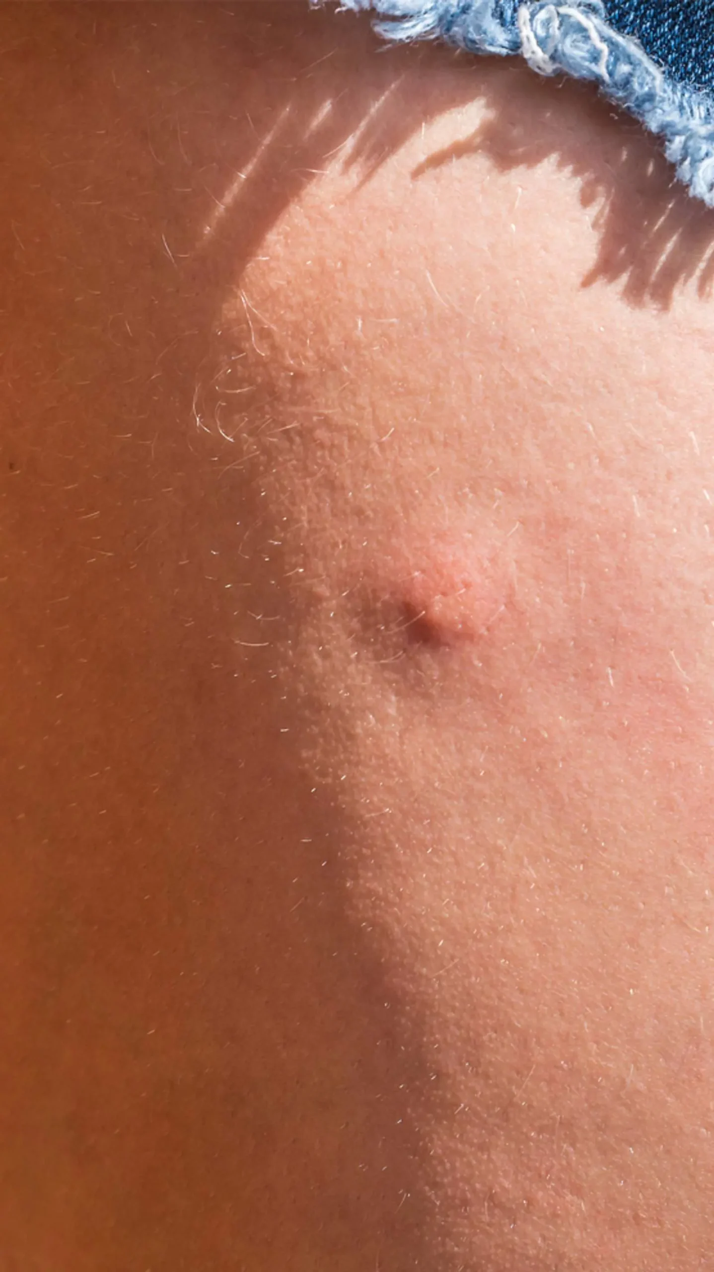 mückenstich hart - Warum wird der Mückenstich hart