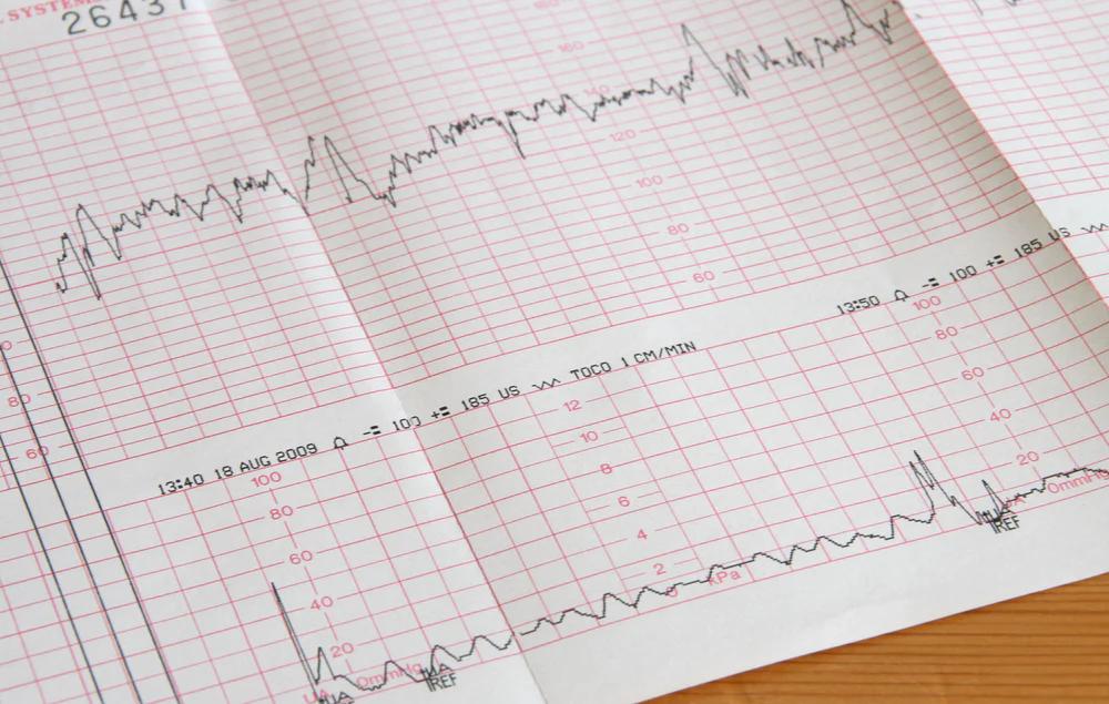 ctg während der geburt - Warum wird kein CTG mehr gemacht