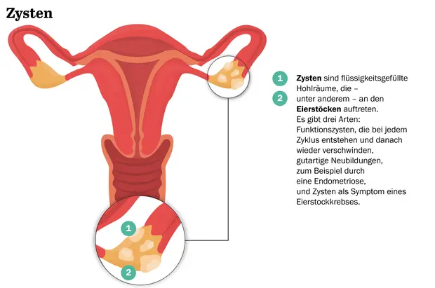 zyste am anfang der schwangerschaft - Warum Zyste in Frühschwangerschaft