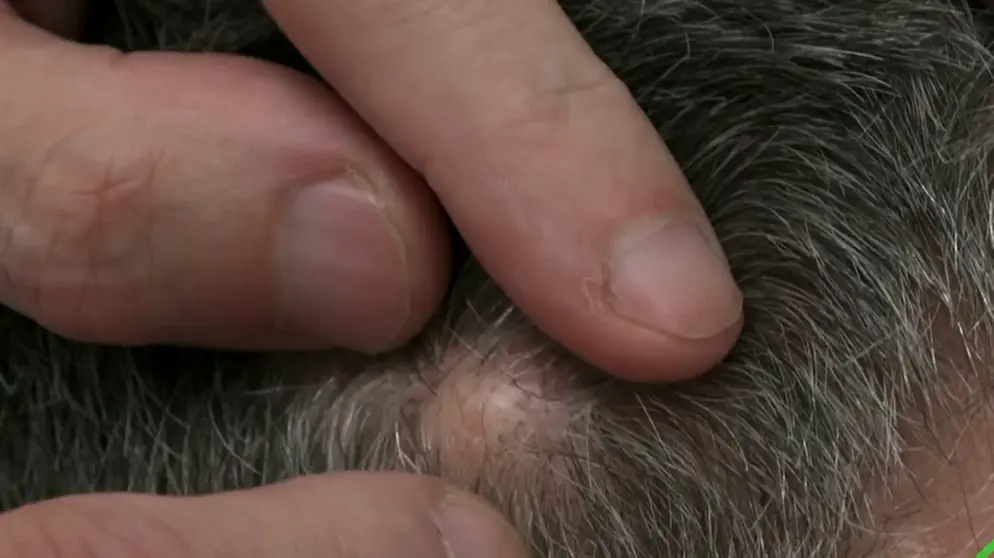 Beule Auf Dem Kopf Tumor