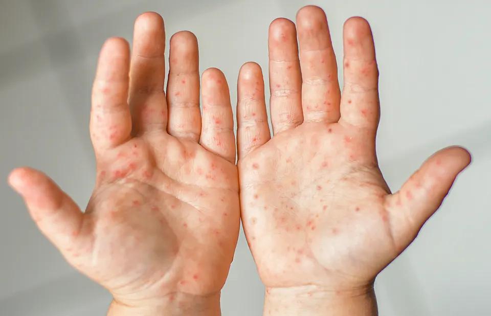 hautausschlag handrücken - Was bedeuten Flecken auf dem Handrücken