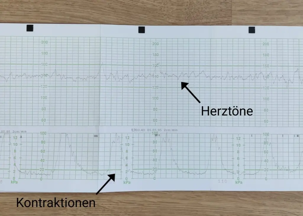 leichte wehen ctg wann geburt - Was bedeuten leichte Wehen auf dem CTG