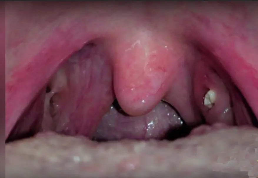 stippen im hals - Was bedeuten Punkte im Rachen