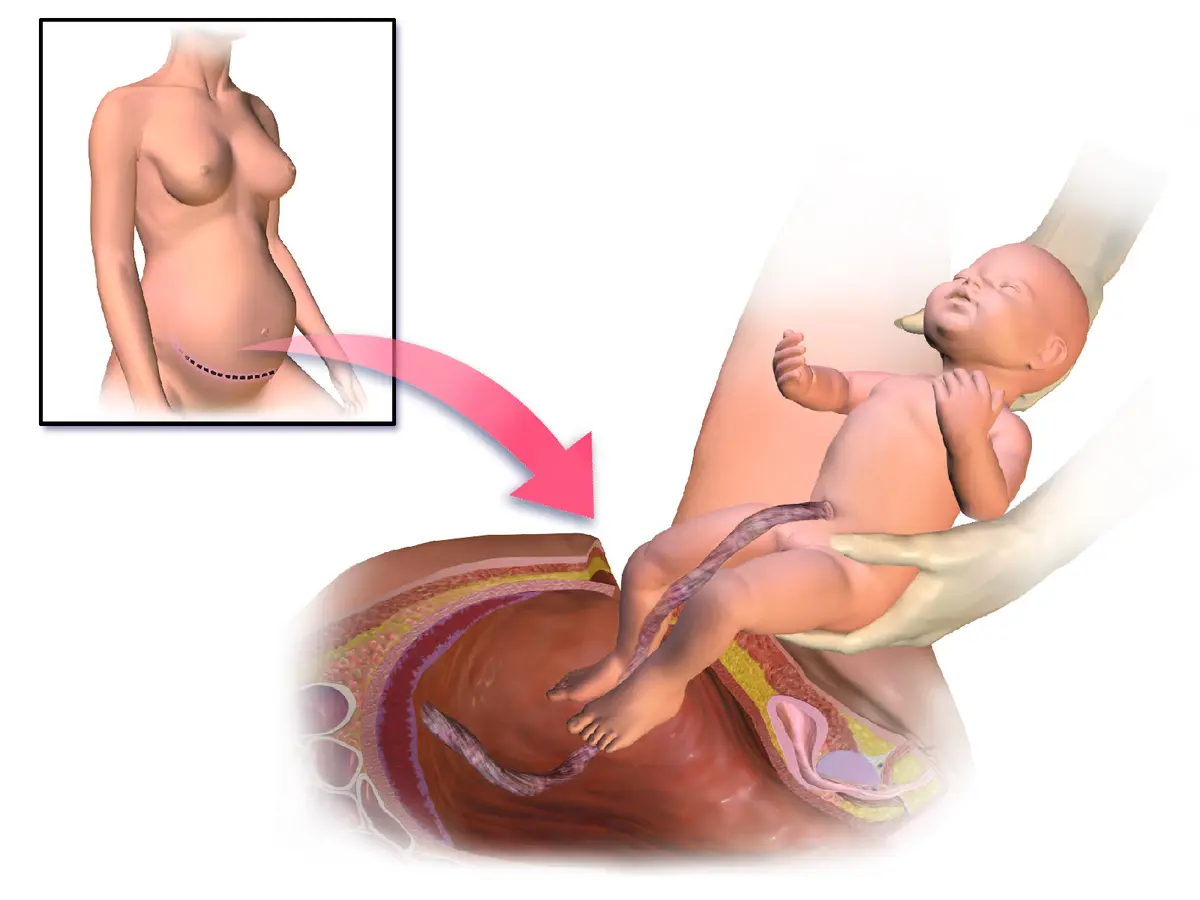 geburt medizinischer ausdruck - Was bedeutet Diagnose partus