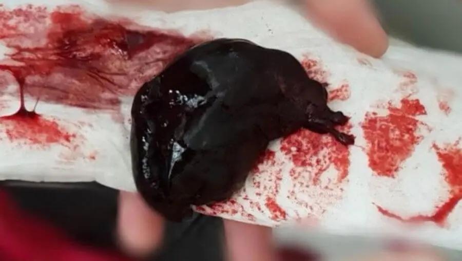 dunkles blut vor geburt - Was bedeutet dunkles Blut in der Schwangerschaft