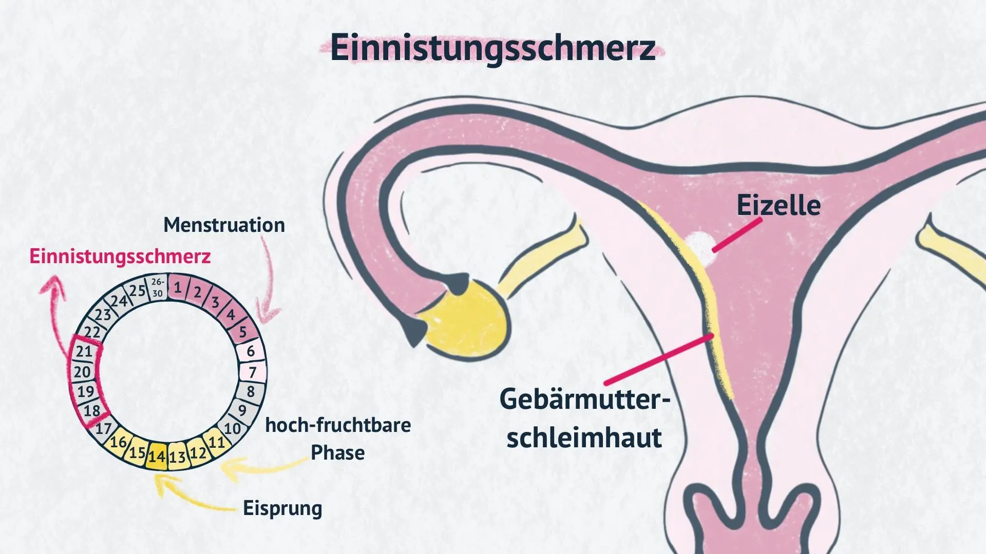 ziehen linker unterbauch schwangerschaft - Was bedeutet ein Ziehen im linken Unterleib