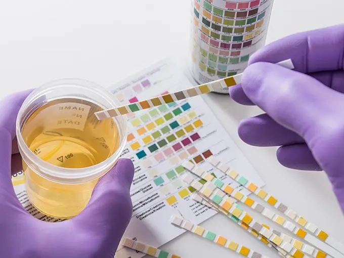 glukose im urin schwangerschaft - Was bedeutet erhöhte Glukose im Urin