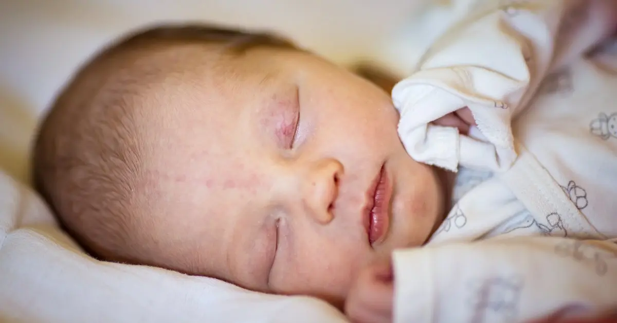 baby rotes augenlid - Was bedeutet es wenn die Augenlider rot sind