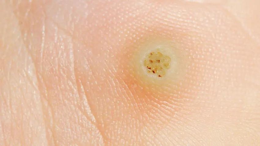 weiße warze augenlid - Was bedeutet es wenn die Warze weiß ist