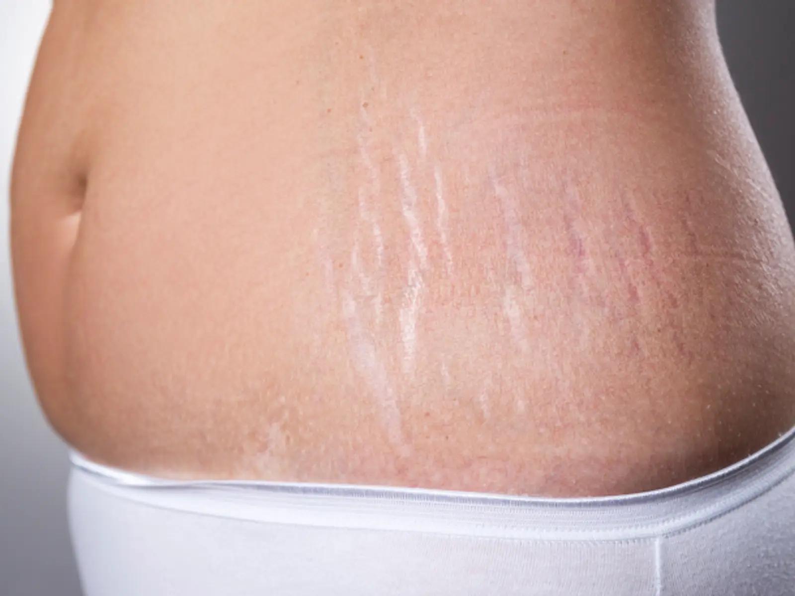 dehnungsstreifen brust schwangerschaft - Was bedeutet es wenn man Dehnungsstreifen an der Brust hat