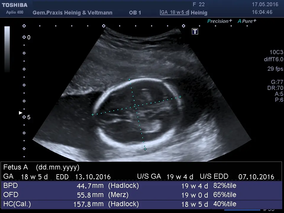 ga schwangerschaft - Was bedeutet GA in der Schwangerschaft