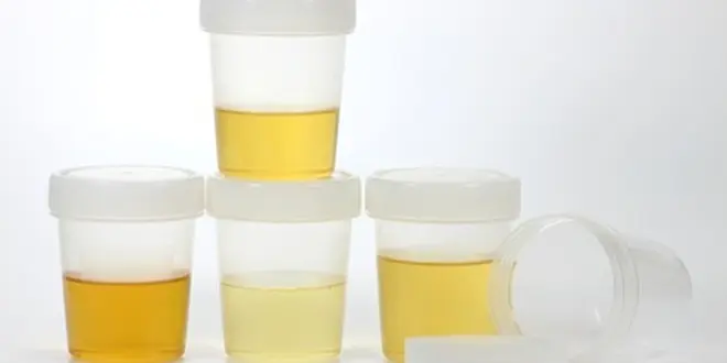 Gelber Urin in der Schwangerschaft: Was bedeutet das? - Was bedeutet grell gelber Urin gelber urin schwangerschaft - Was bedeutet grell gelber Urin