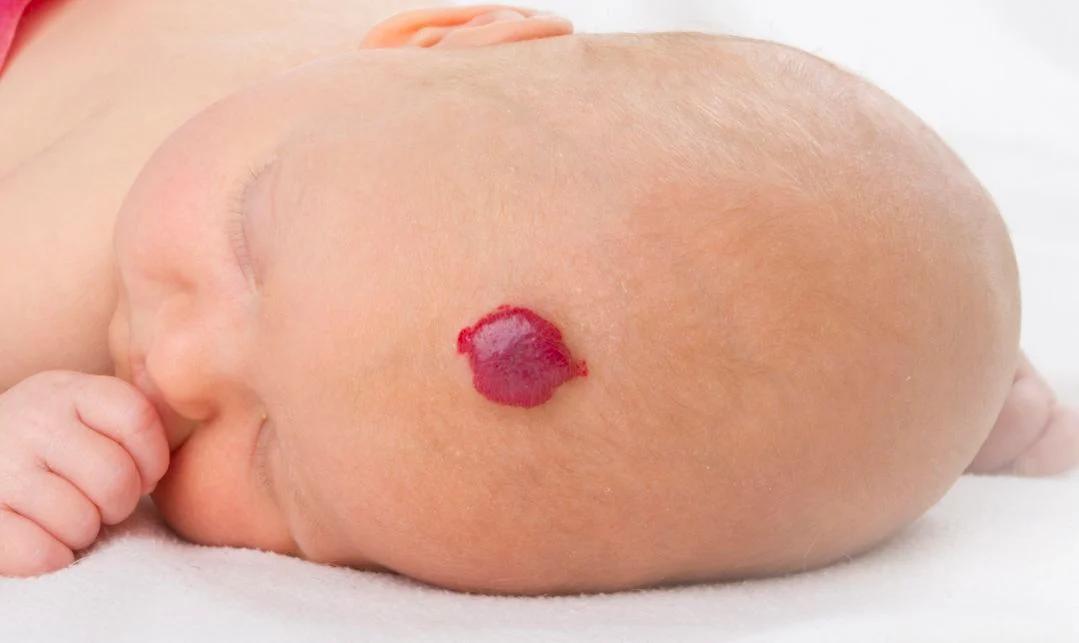 hämangiom baby - Was bedeutet Hämangiom bei Neugeborenen