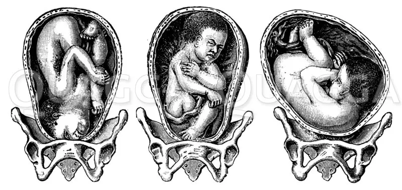 gesichtslage geburt - Was bedeutet Mentoposterior