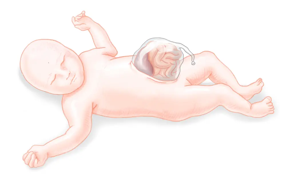 omphalozele überlebenschance - Was bedeutet Omphalozele