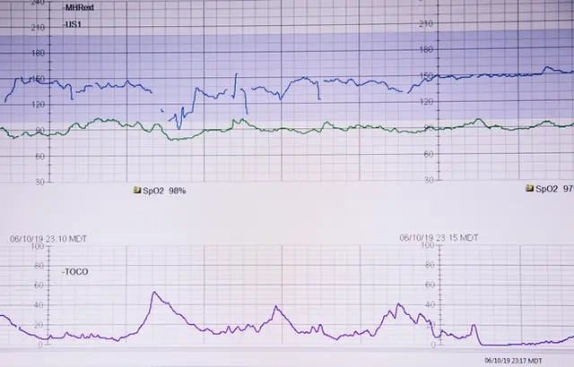 ctg wehen werte geburt - Was bedeutet Toko bei CTG