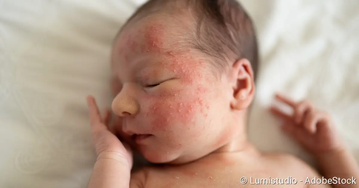 babyakne wann - Was begünstigt Babyakne