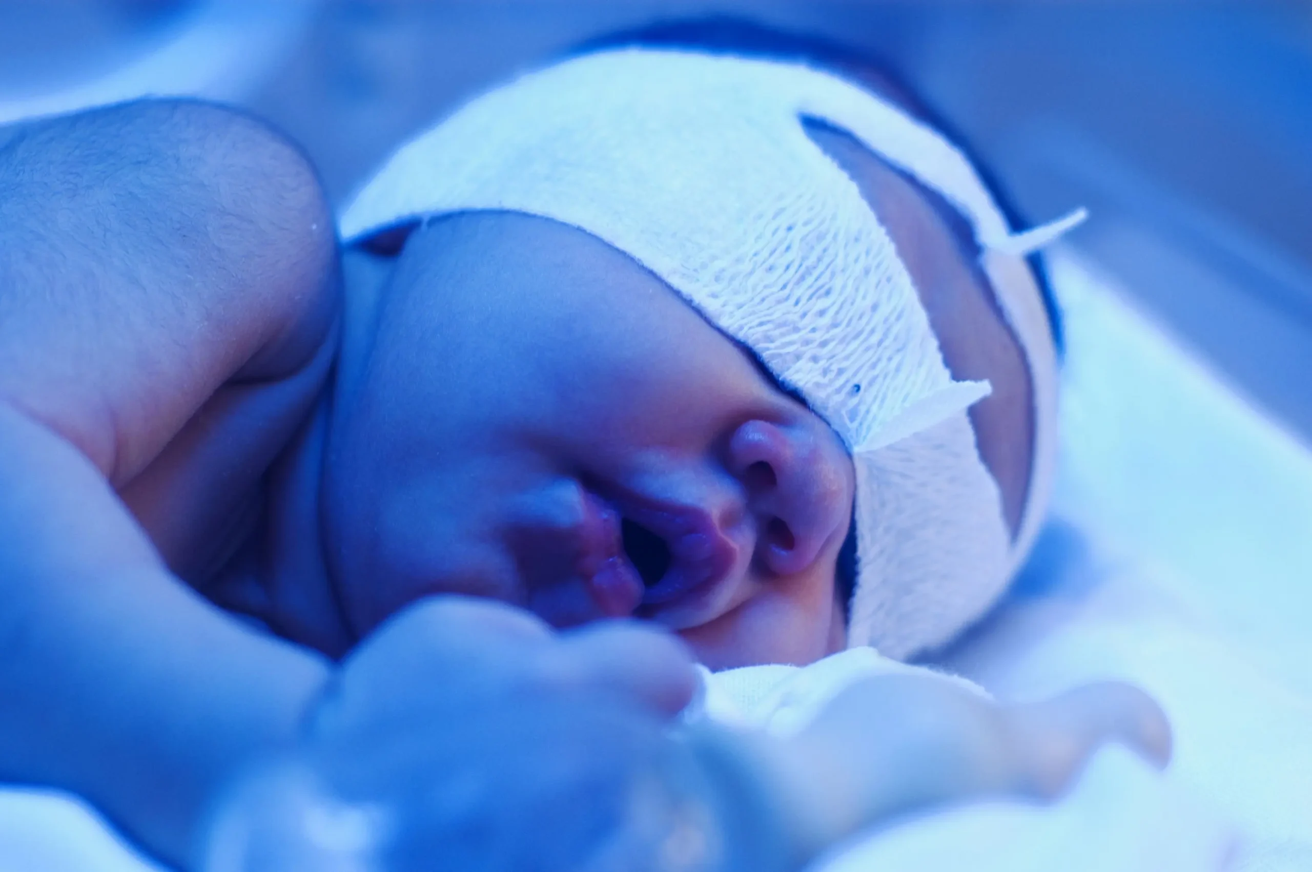 Phototherapie bei Neugeborenen: Eine sichere und effektive Behandlung von Gelbsucht - Was bewirkt blaues Licht bei Babys phototherapie neugeborenes - Was bewirkt blaues Licht bei Babys