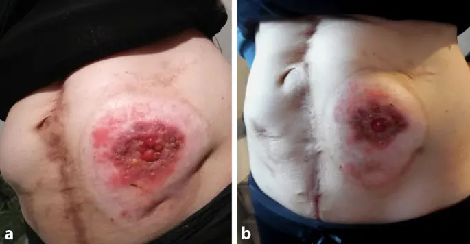 stoma schwangerschaft - Was darf man mit einem Stoma nicht machen