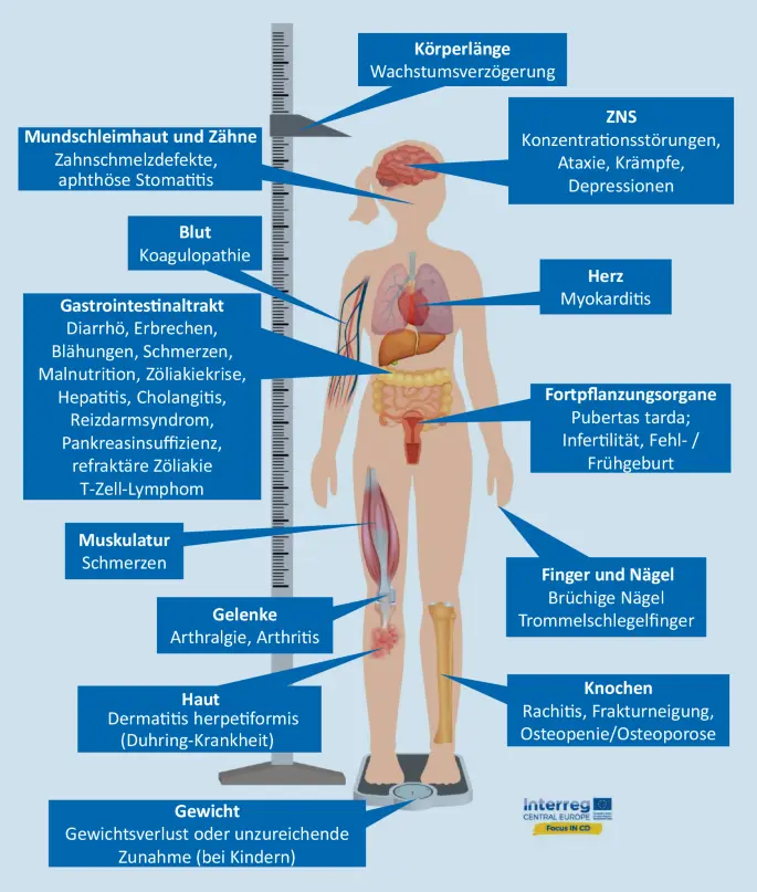 symptome zöliakie kind - Was dürfen Kinder mit Zöliakie nicht essen