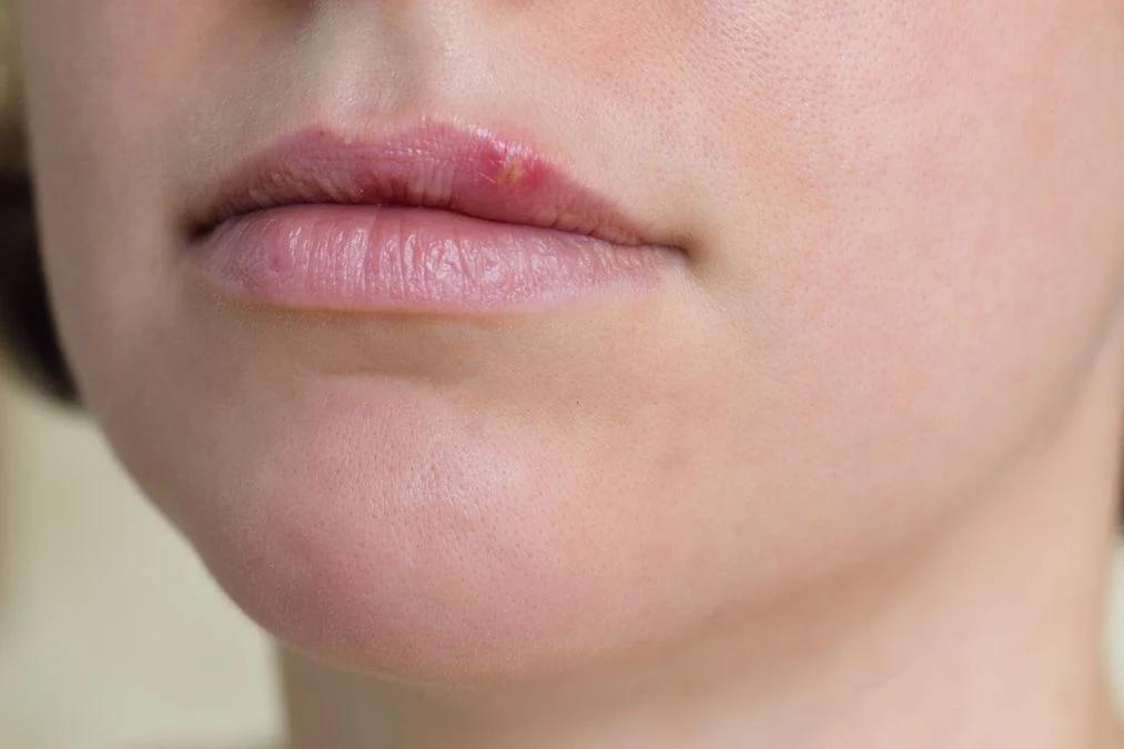 herpes anzeichen schwangerschaft - Was fehlt dem Körper wenn man Herpes hat