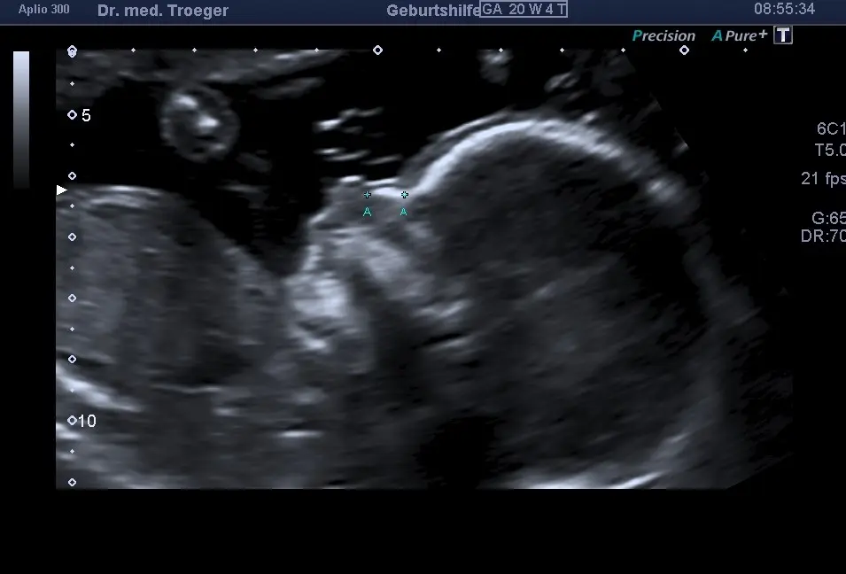 ga schwangerschaft - Was heißt Ga nach LP