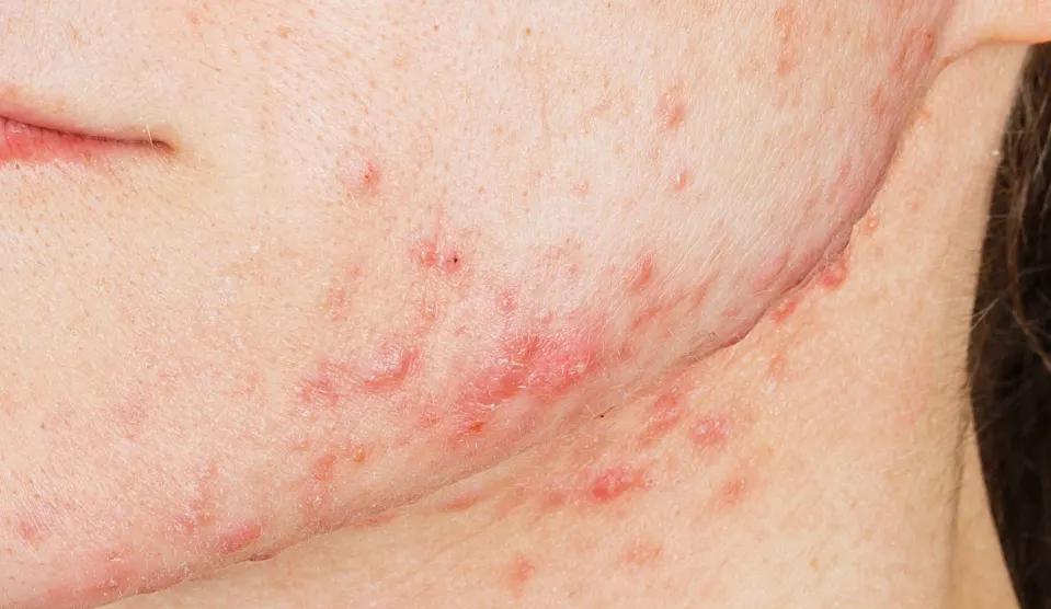 Allergischer Ausschlag im Gesicht: Ursachen, Symptome und Behandlung - Was hilft bei allergischem Ausschlag im Gesicht allergische reaktion milben ausschlag im gesicht - Was hilft bei allergischem Ausschlag im Gesicht