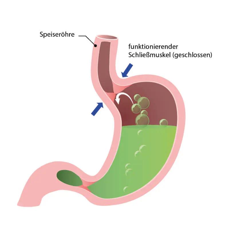 Gereizte Speiseröhre: Ursachen, Symptome und Behandlung - Was hilft bei gereizter Speiseröhre gereizte speiseröhre - Was hilft bei gereizter Speiseröhre