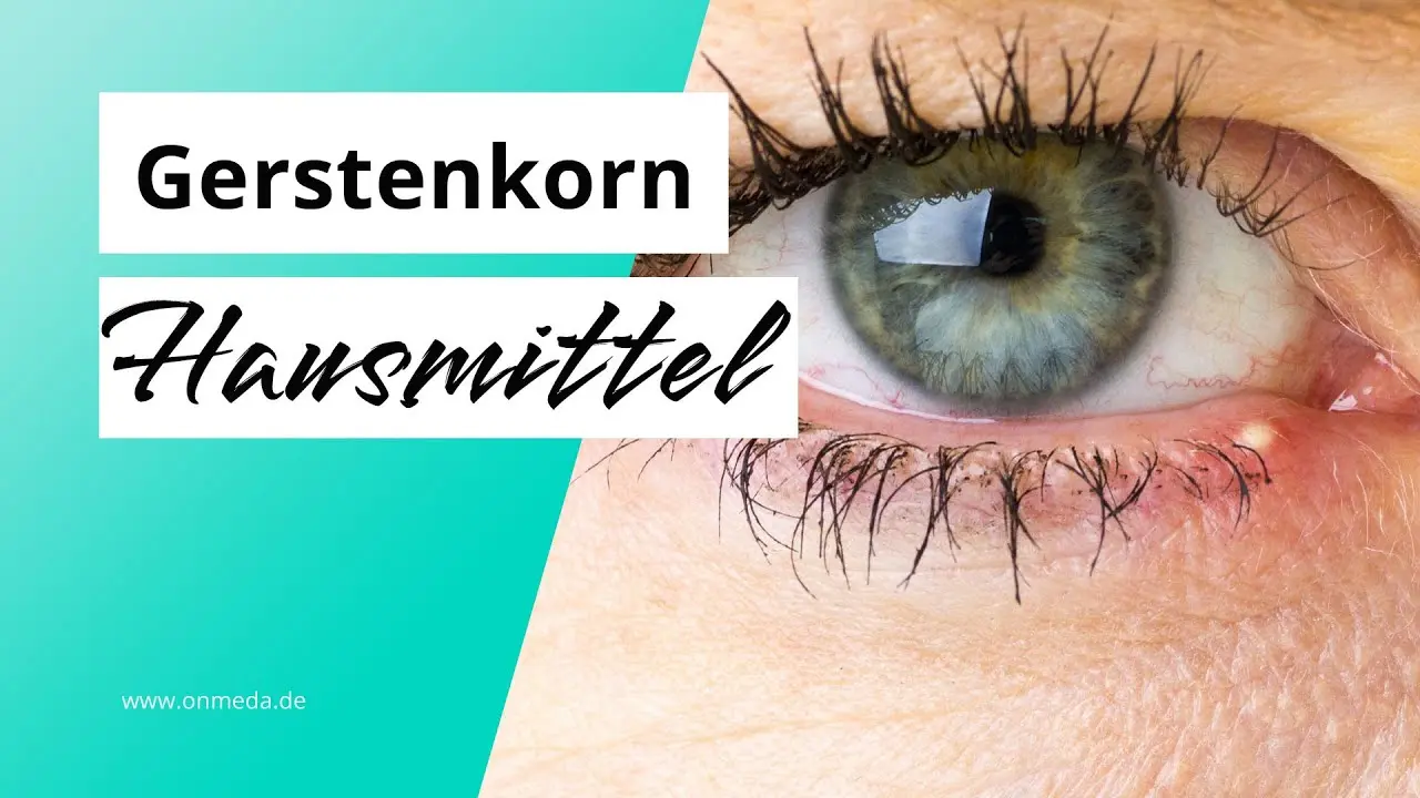 Gerstenkorn Hausmittel: Natürliche Linderung für geschwollene Augenlider - Was hilft bei Gerstenkorn rezeptfrei gerstenkorn hausmittel - Was hilft bei Gerstenkorn rezeptfrei