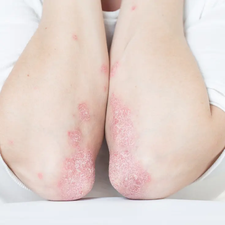 juckreiz ellenbogen außen - Was hilft bei juckenden Ellenbogen