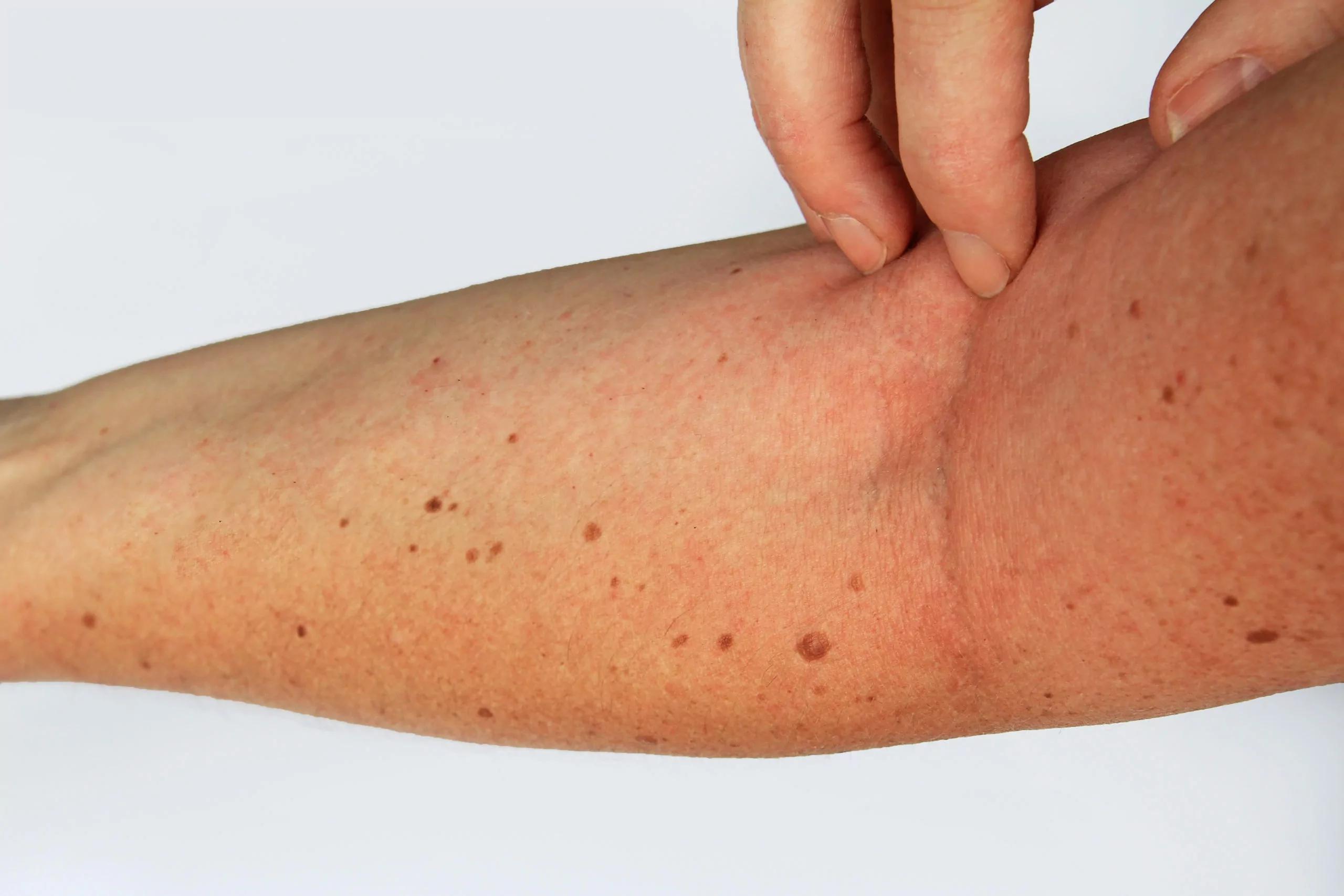 globuli für neurodermitis - Was hilft bei Neurodermitis Naturheilkunde