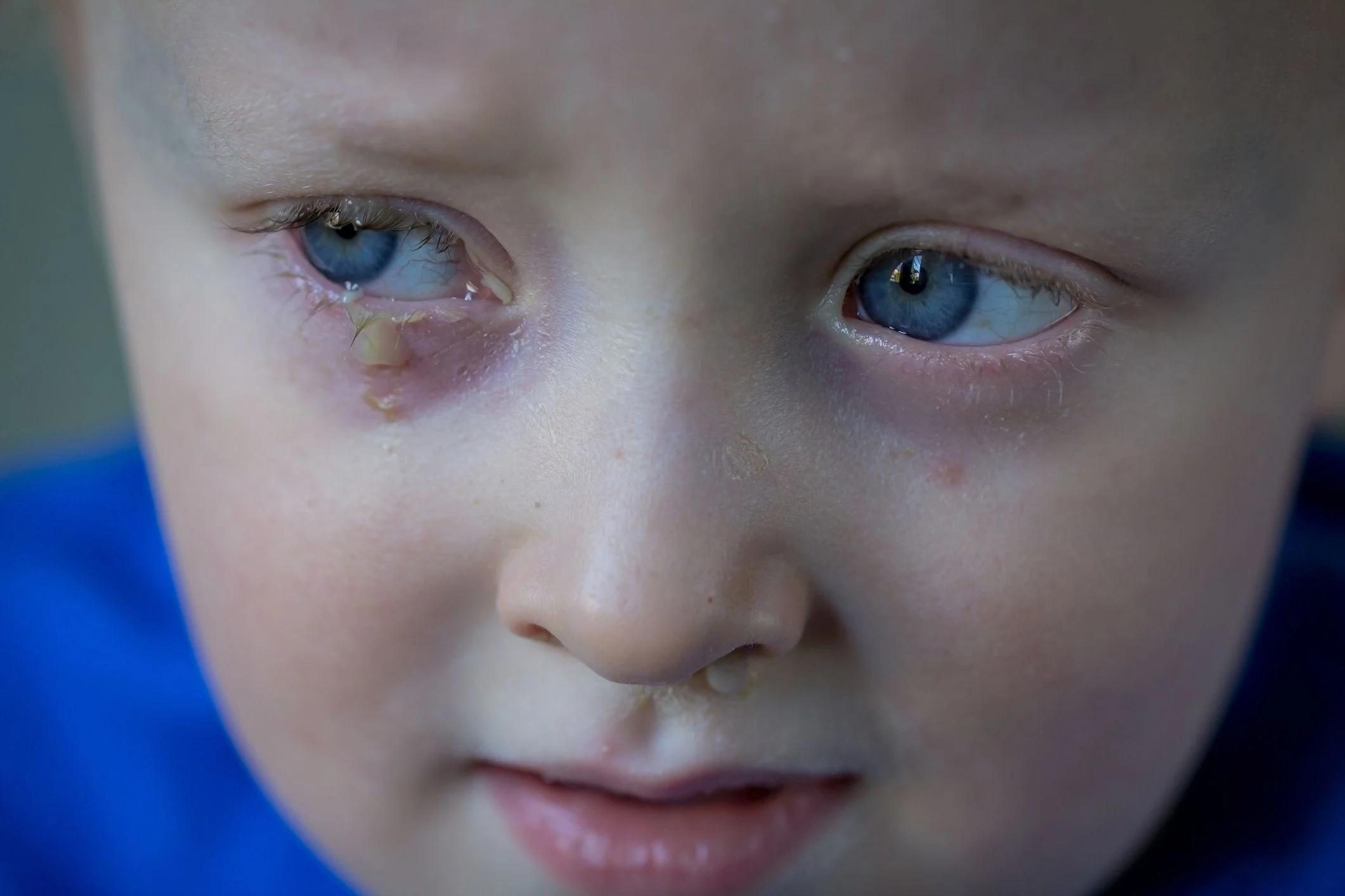 auge eitert kind - Was hilft gegen Eiter im Auge